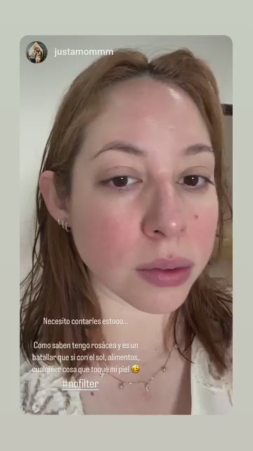 Kit Rosácea | Rojeces